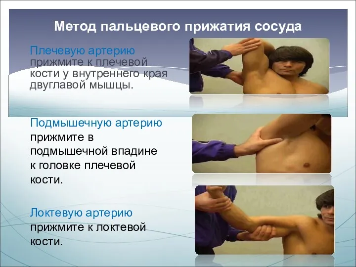 Метод пальцевого прижатия сосуда Плечевую артерию прижмите к плечевой кости