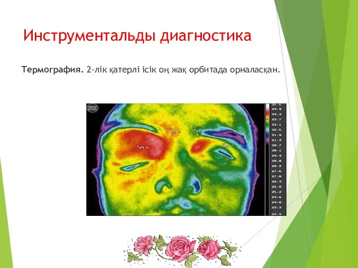 Инструментальды диагностика Термография. 2-лік қатерлі ісік оң жақ орбитада орналасқан.