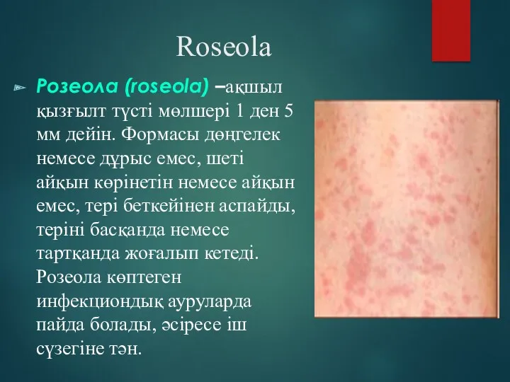 Roseola Розеола (roseola) –ақшыл қызғылт түсті мөлшері 1 ден 5