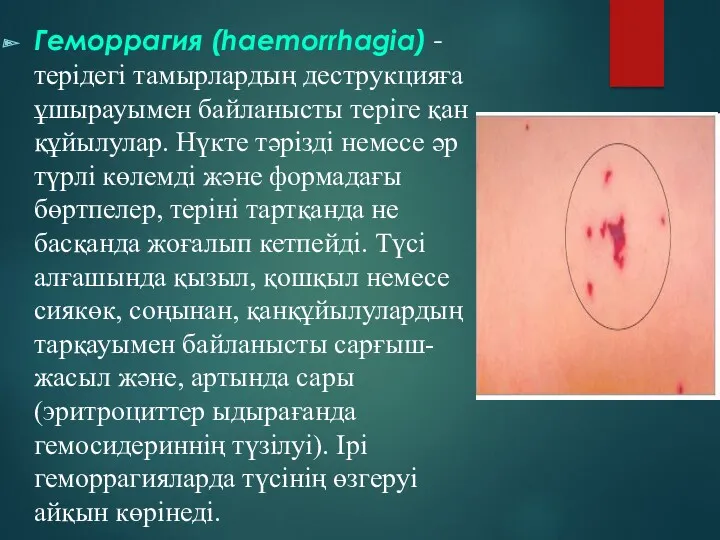 Геморрагия (haemorrhagia) - терідегі тамырлардың деструкцияға ұшырауымен байланысты теріге қан құйылулар. Нүкте тәрізді