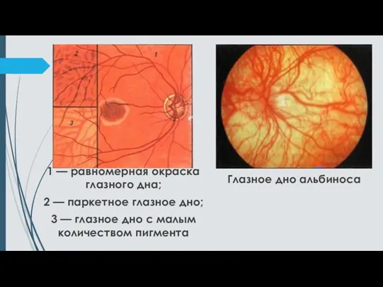 1 — равномерная окраска глазного дна; 2 — паркетное глазное