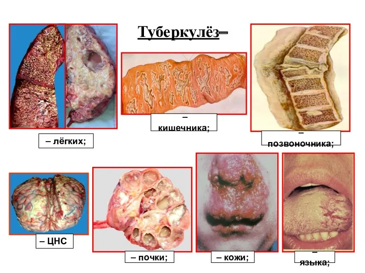 Туберкулёз– – позвоночника; – кишечника; – лёгких; – почки; – кожи; – языка; – ЦНС