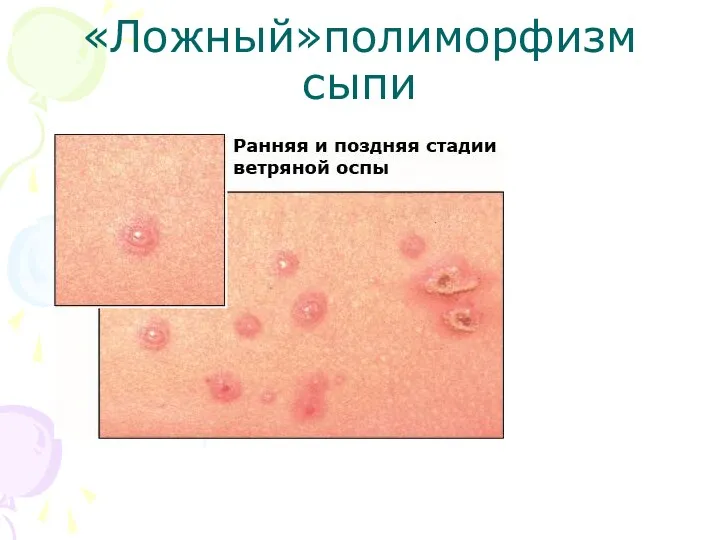 «Ложный»полиморфизм сыпи