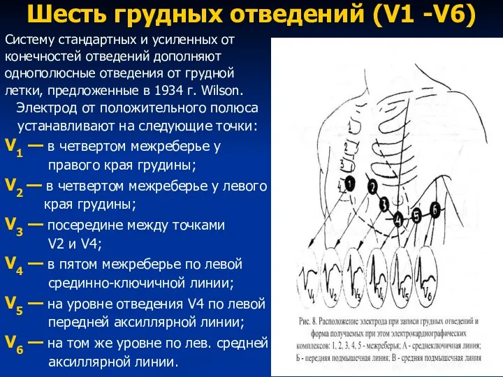 Шесть грудных отведений (V1 -V6) Систему стандартных и усиленных от