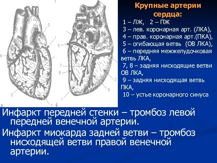 Инфаркт передней стенки – тромбоз левой передней венечной артерии. Инфаркт