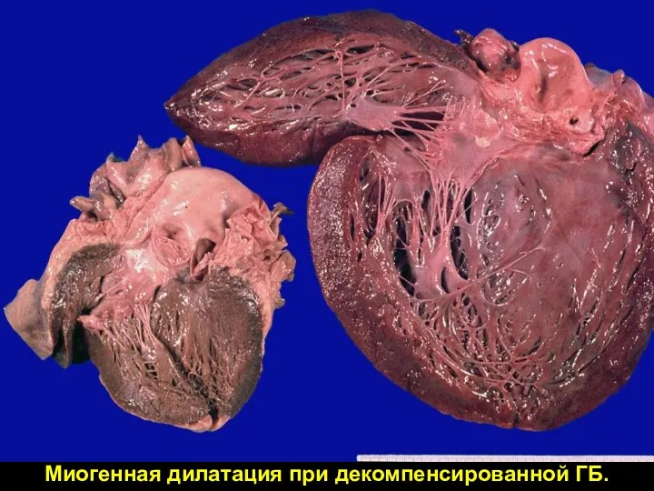 Миогенная дилатация при декомпенсированной ГБ.