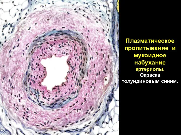 Плазматическое пропитывание и мукоидное набухание артериолы. Окраска толуидиновым синим.