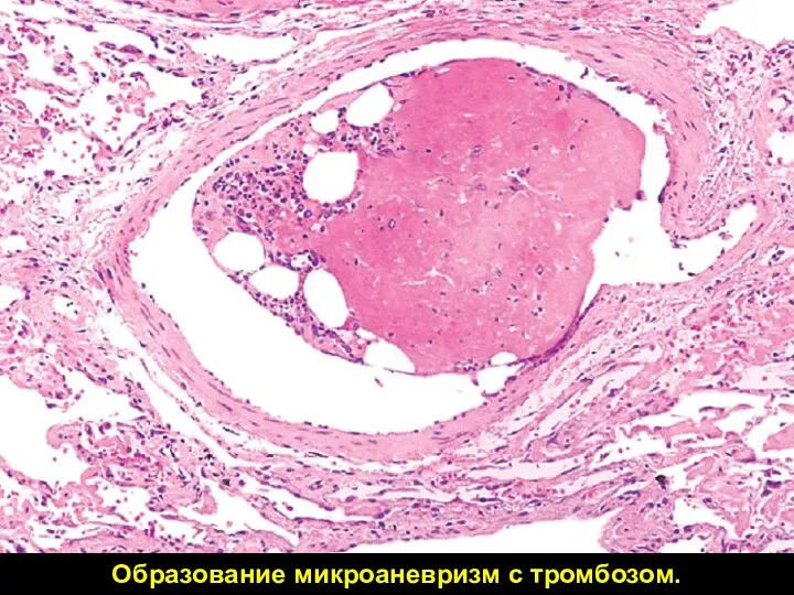 Образование микроаневризм с тромбозом.