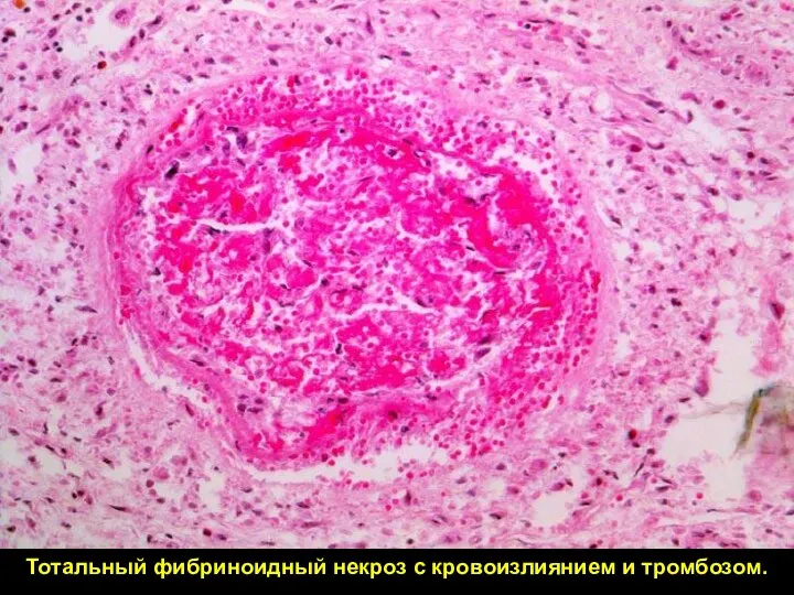 Тотальный фибриноидный некроз с кровоизлиянием и тромбозом.