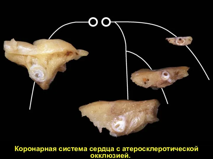 Коронарная система сердца с атеросклеротической окклюзией.