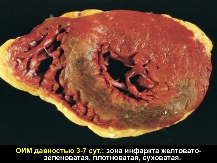ОИМ давностью 3-7 сут.: зона инфаркта желтовато-зеленоватая, плотноватая, суховатая.