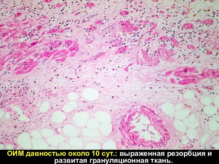 ОИМ давностью около 10 сут.: выраженная резорбция и развитая грануляционная ткань.