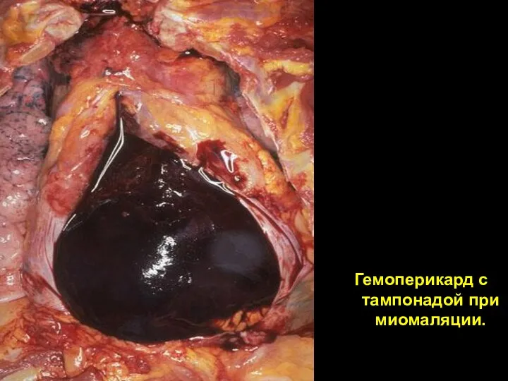 Гемоперикард с тампонадой при миомаляции.