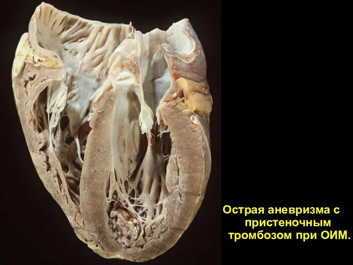 Острая аневризма с пристеночным тромбозом при ОИМ.