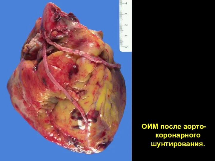 ОИМ после аорто-коронарного шунтирования.