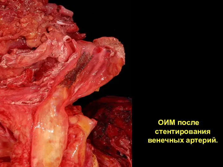 ОИМ после стентирования венечных артерий.