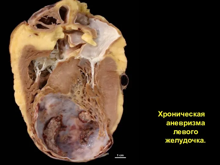 Хроническая аневризма левого желудочка.