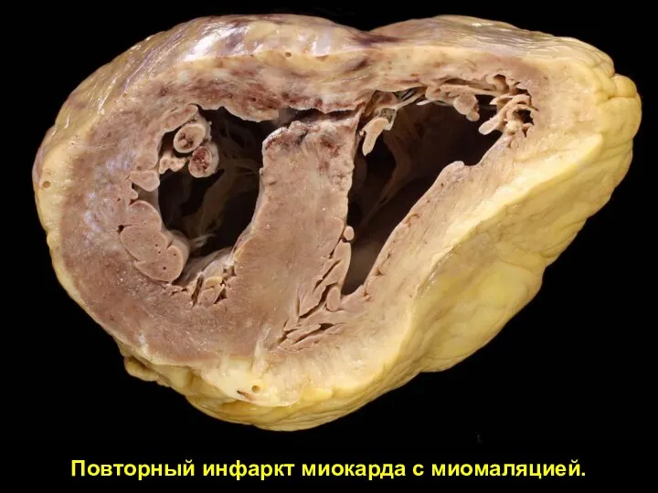 Повторный инфаркт миокарда с миомаляцией.