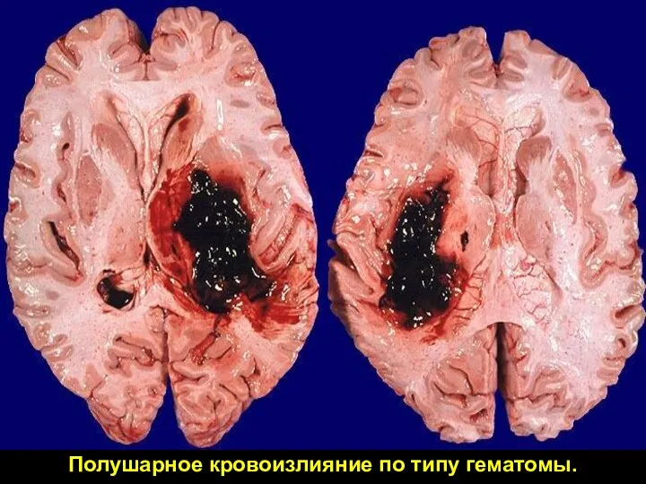 Полушарное кровоизлияние по типу гематомы.