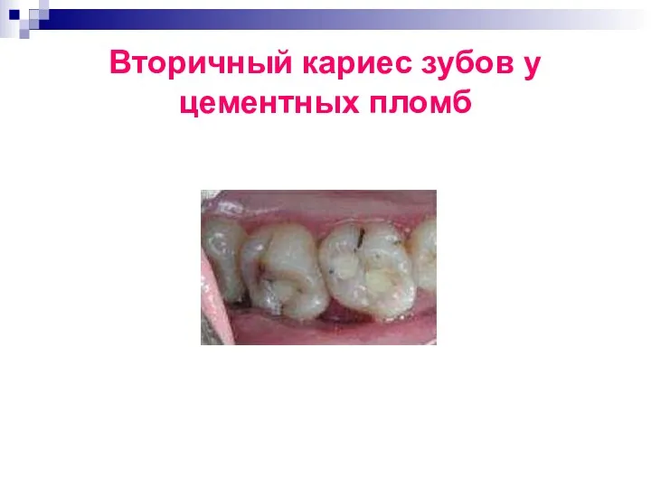 Вторичный кариес зубов у цементных пломб