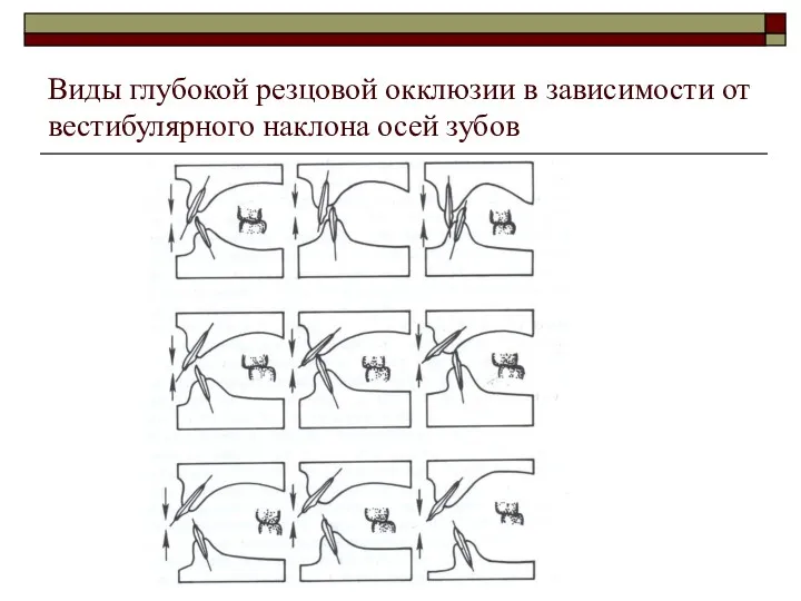 Виды глубокой резцовой окклюзии в зависимости от вестибулярного наклона осей зубов