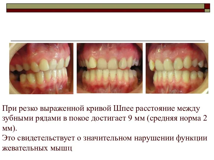 При резко выраженной кривой Шпее расстояние между зубными рядами в покое достигает 9