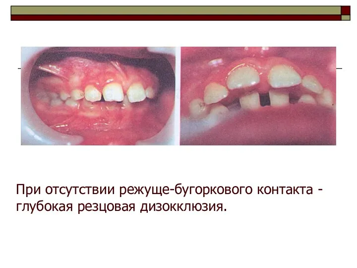 При отсутствии режуще-бугоркового контакта - глубокая резцовая дизокклюзия.