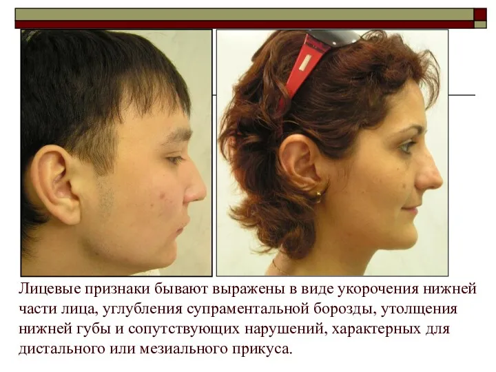 Лицевые признаки бывают выражены в виде укорочения нижней части лица, углубления супраментальной борозды,