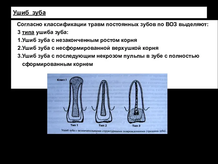 Ушиб зуба Согласно классификации травм постоянных зубов по ВОЗ выделяют: