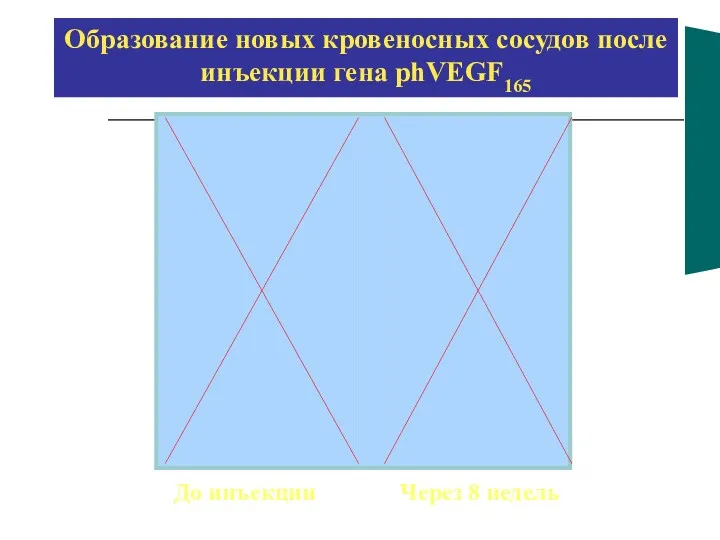 Образование новых кровеносных сосудов после инъекции гена phVEGF165 До инъекции Через 8 недель