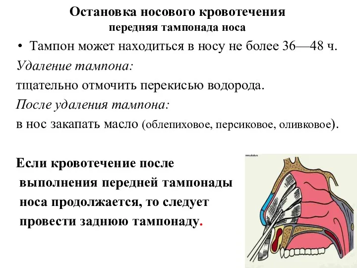 Остановка носового кровотечения передняя тампонада носа Тампон может находиться в