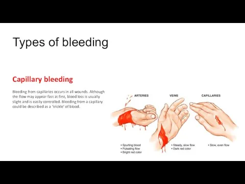 Types of bleeding Capillary bleeding Bleeding from capillaries occurs in