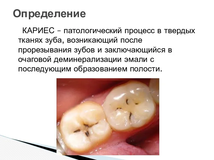 КАРИЕС – патологический процесс в твердых тканях зуба, возникающий после