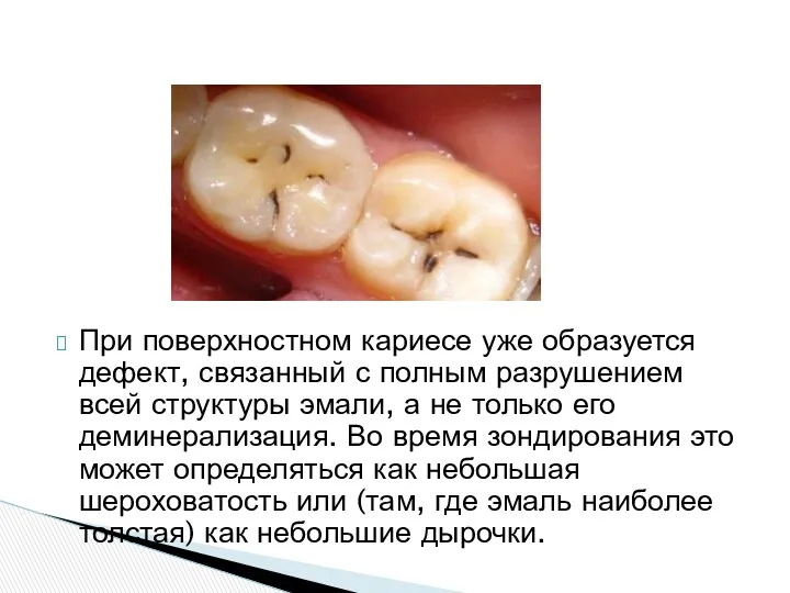 При поверхностном кариесе уже образуется дефект, связанный с полным разрушением