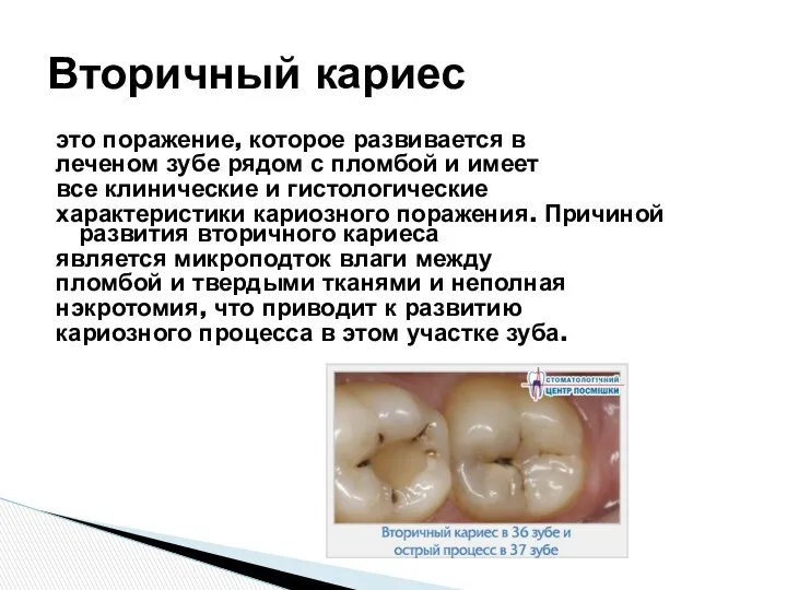 это поражение, которое развивается в леченом зубе рядом с пломбой