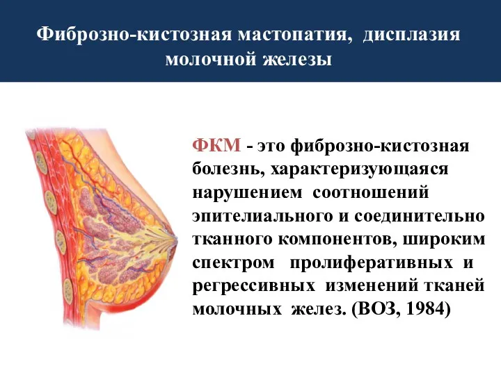 Фиброзно-кистозная мастопатия, дисплазия молочной железы ФКМ - это фиброзно-кистозная болезнь,