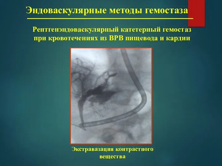 Эндоваскулярные методы гемостаза Рентгенэндоваскулярный катетерный гемостаз при кровотечениях из ВРВ пищевода и кардии Экстравазация контрастного вещества