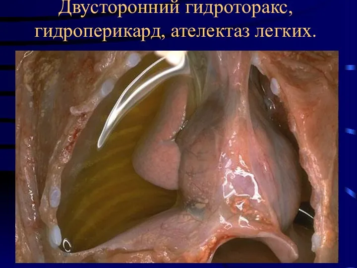 Двусторонний гидроторакс, гидроперикард, ателектаз легких.