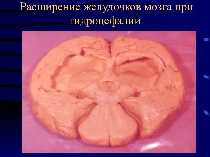 Расширение желудочков мозга при гидроцефалии