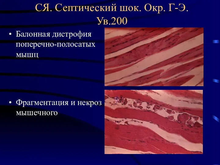 СЯ. Септический шок. Окр. Г-Э. Ув.200 Балонная дистрофия поперечно-полосатых мышц Фрагментация и некроз мышечного
