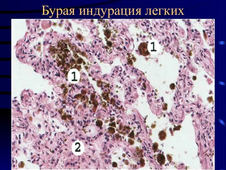 Бурая индурация легких