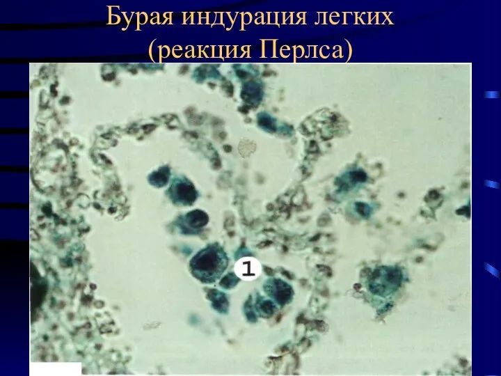 Бурая индурация легких (реакция Перлса)