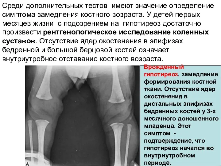 Среди дополнительных тестов имеют значение определение симптома замедления костного возраста.