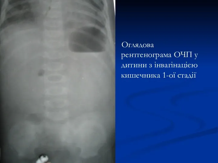 Оглядова рентгенограма ОЧП у дитини з інвагінацією кишечника 1-ої стадії