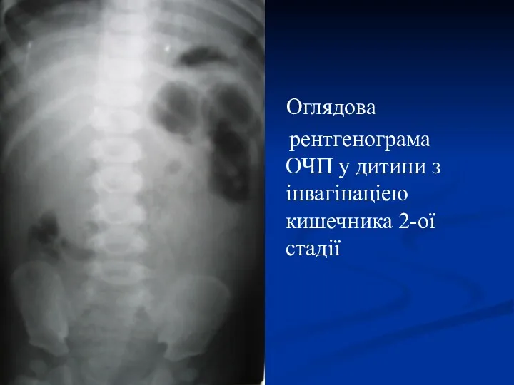 Оглядова рентгенограма ОЧП у дитини з інвагінаціею кишечника 2-ої стадії