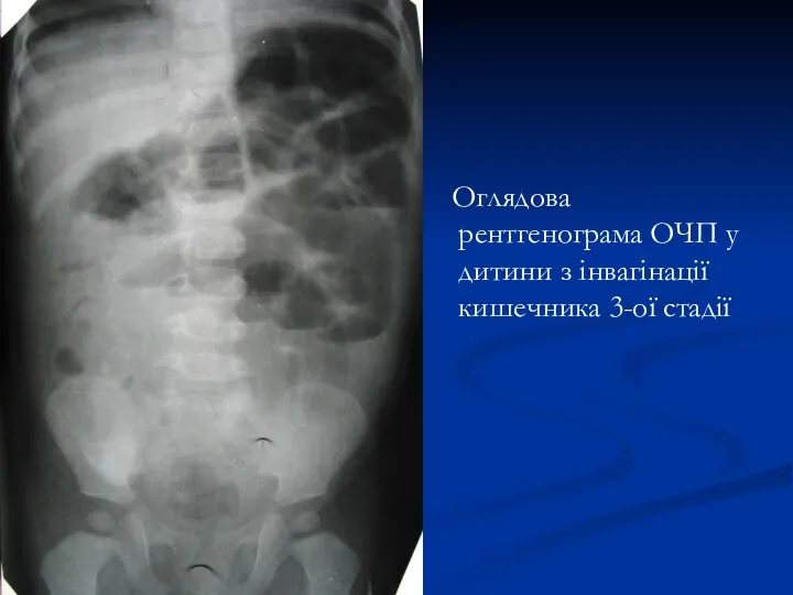 Оглядова рентгенограма ОЧП у дитини з інвагінації кишечника 3-ої стадії
