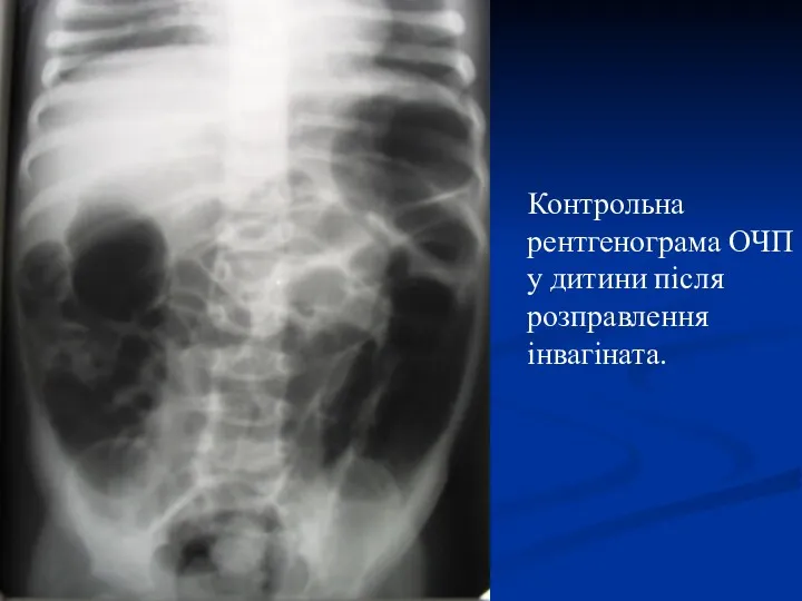 Контрольна рентгенограма ОЧП у дитини після розправлення інвагіната.