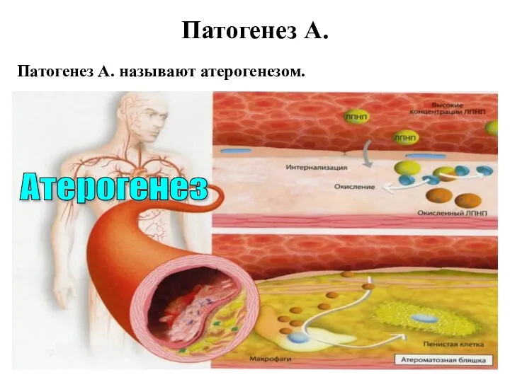 Атерогенез Патогенез А. Патогенез А. называют атерогенезом.