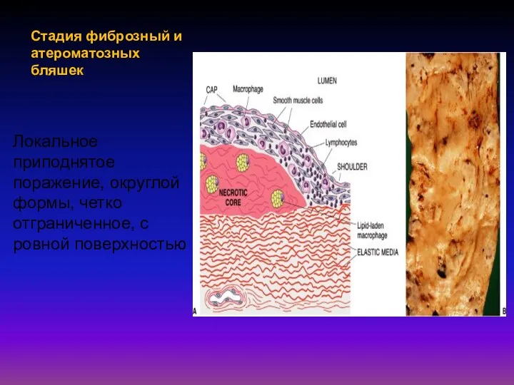 Стадия фиброзный и атероматозных бляшек Локальное приподнятое поражение, округлой формы, четко отграниченное, с ровной поверхностью