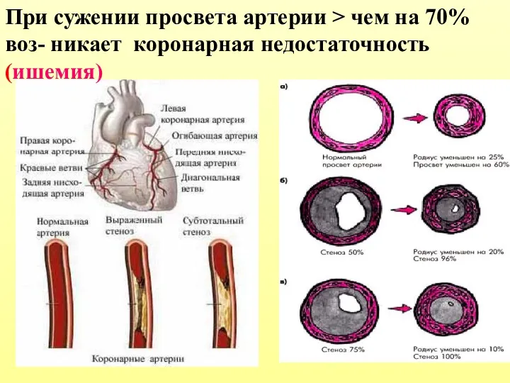 При сужении просвета артерии > чем на 70% воз- никает коронарная недостаточность (ишемия)